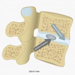 Image 4: Vertebral Disc