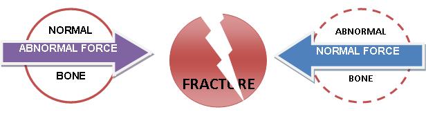 Fracture Develop